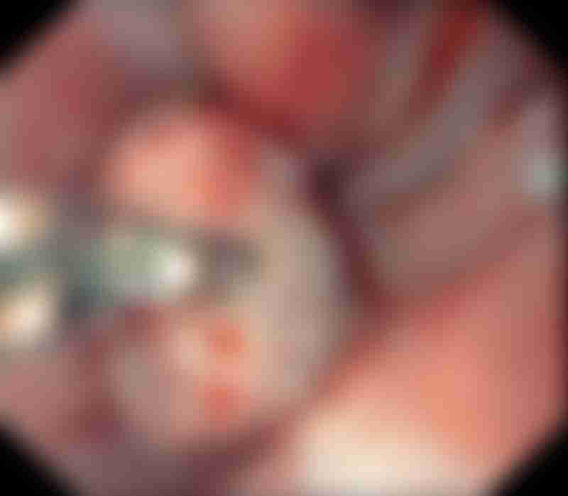Stomach Cancer Endoscopy View